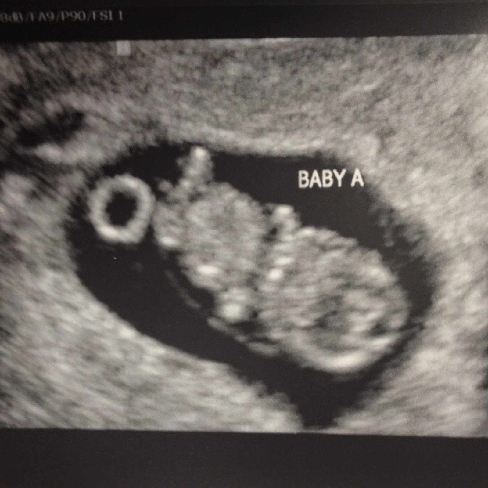 Like pulling teeth Ultrasound 2 How many babies are in there?