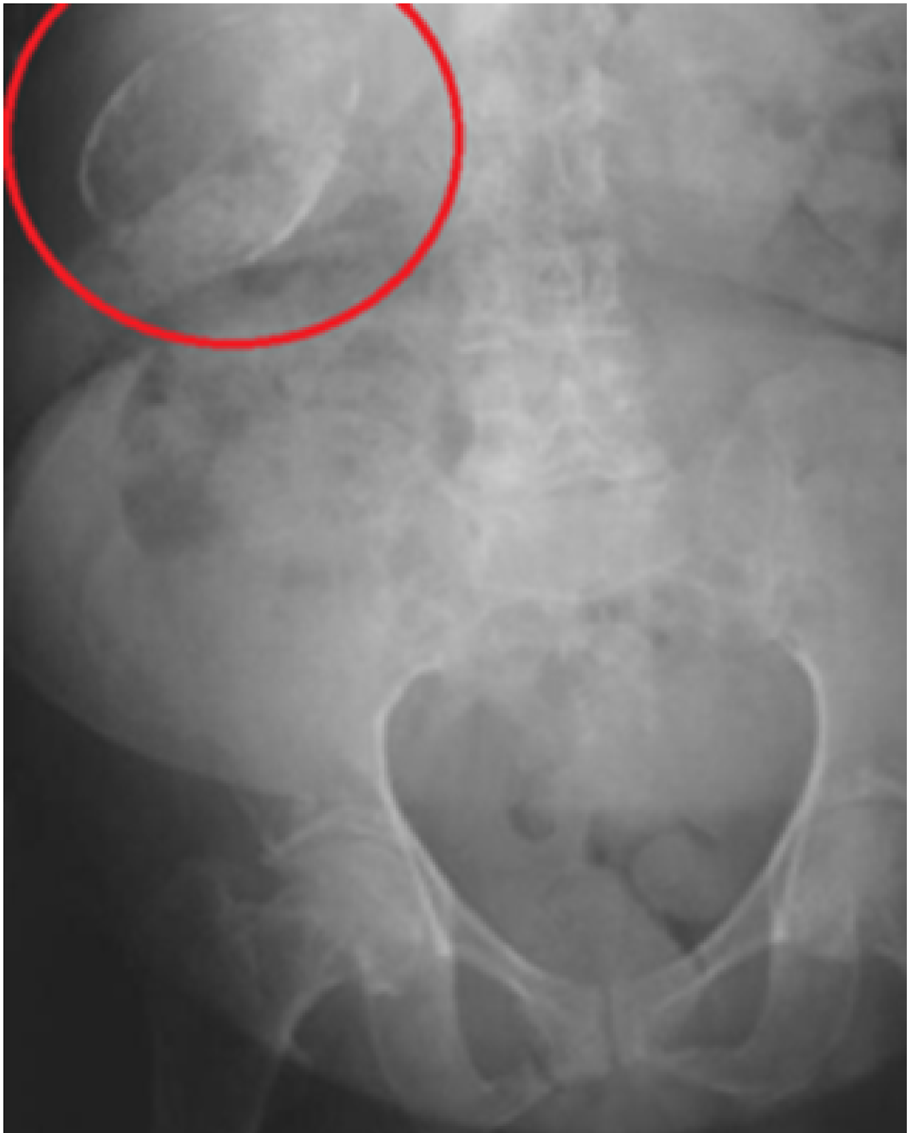 MBBS Medicine (Humanity First) Gallstones