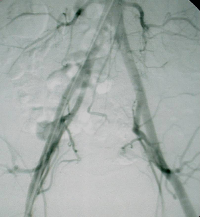 Episacral-Lipoma Sacral Lipoma http://mrimedicvn.blogspot.com/2011/04/sacral-chordoma ...