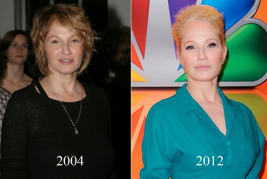 Ellen Barkin Plastic Surgery Facelift, Botox Injections, Nose Jobs, Lip