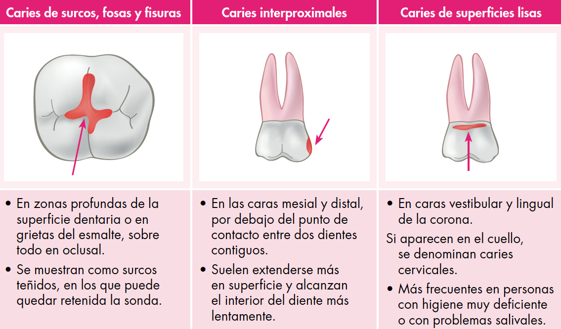 Tipos de caries