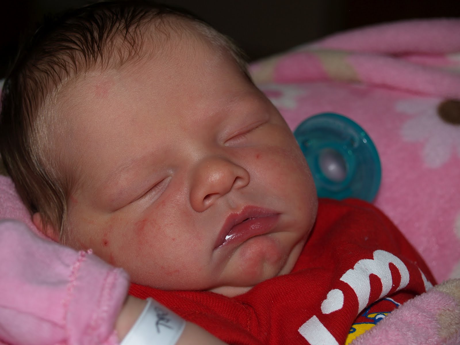 Stork Bite Vs Strawberry Mark