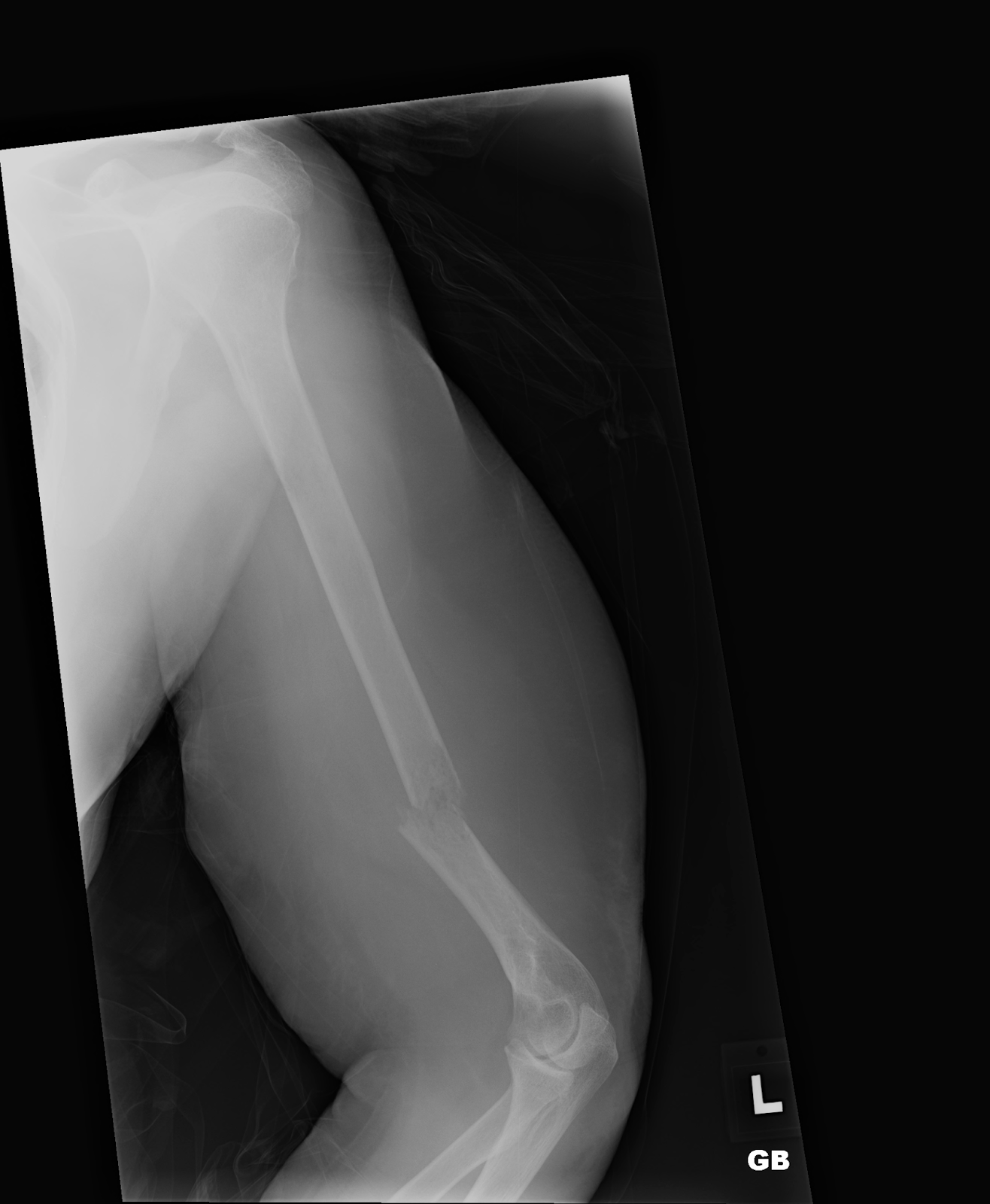 Pathological Fractures Humerus Fracture-2.bp.blogspot.com