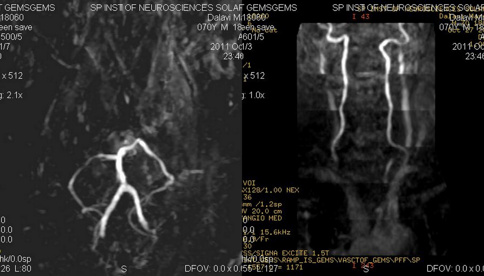 infarct involving the left basal ganglia infarct involving the left basal ganglia