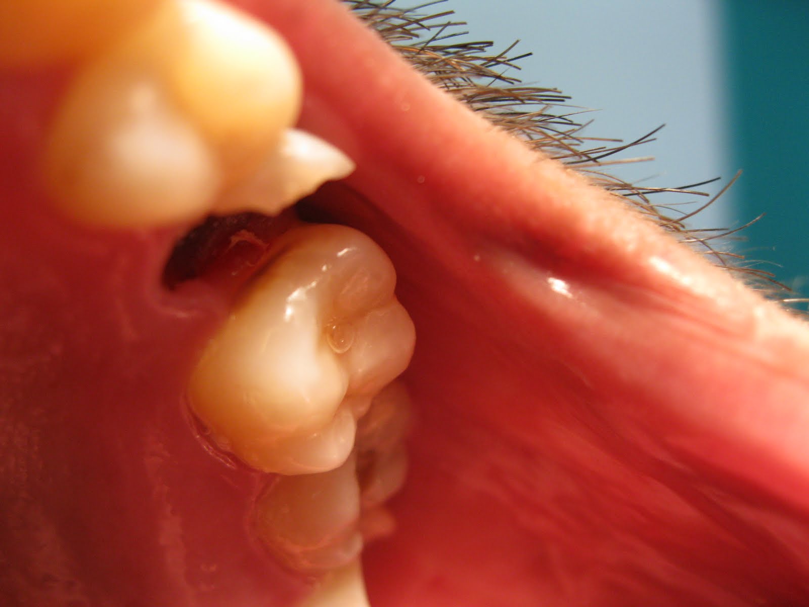 DENTO CARE DENTAL CLINICS Post And CoreRestoration Of Extraction