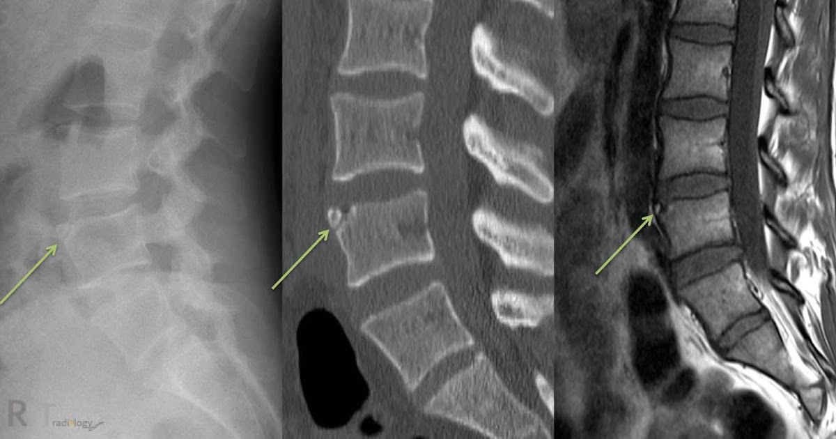 Ring Apophysis Cervical Spine Ring Apophysis Cervical Spine