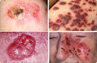 skin cancer Malignant Melanoma