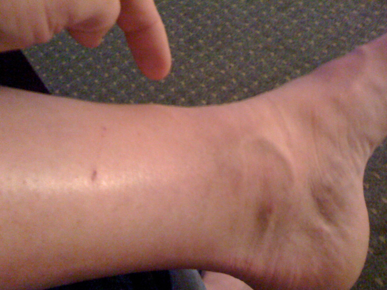 Bumps On Shin