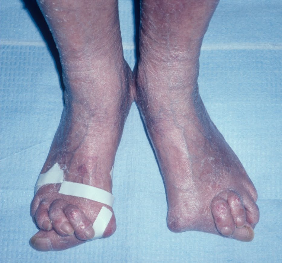 Arthritis Deformities
