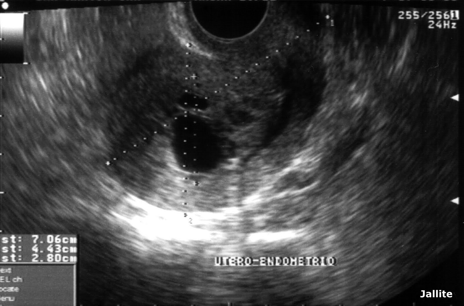 Swiss Cheese Endometrium Is Seen In at Raymond Ward blog