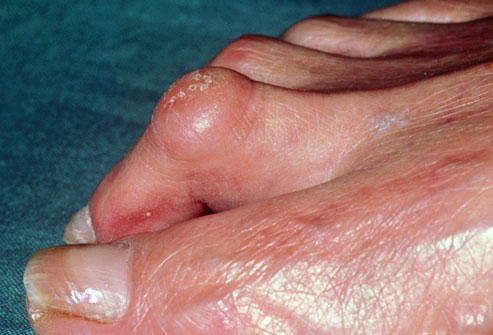 toe box dermatitis