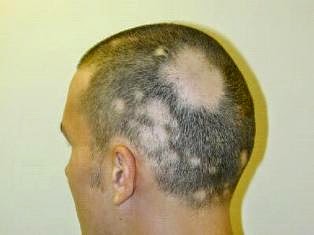 Study Medical Photos A 32 Year Old Man Presents With Hair Loss