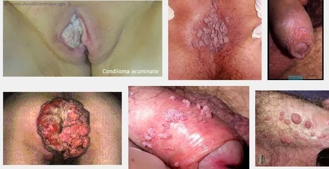 Jenis Obat Untuk Kondiloma Akuminata Jenis Obat Untuk Kondiloma Akuminata