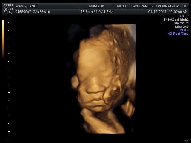 3d Sensing And Visualization 3d 4d Ultrasound Scans