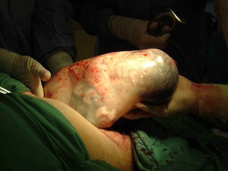 a cesarean delivery Los angeles california obstetrician-gynecologist doctors physician directory - learn about c-section (cesarean birth) options, and reasons for a c-section delivery including multiple births, health problems, problems with the pelvis, placenta, or umbilical cord. a cesarean delivery Los angeles california obstetrician-gynecologist doctors physician directory - learn about c-section (cesarean birth) options, and reasons for a c-section delivery including multiple births, health problems, problems with the pelvis, placenta, or umbilical cord.