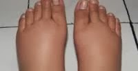 Download Betis Kaki Bengkak Pictures