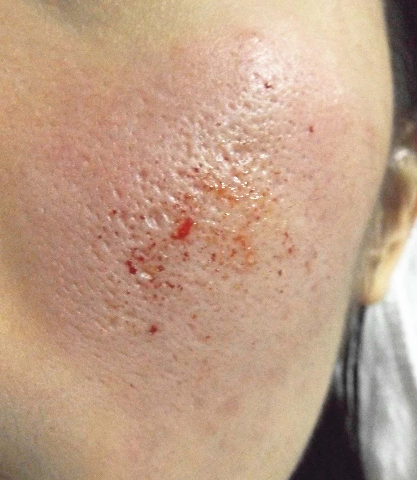 [Treatment] Depressed Acne Scars After Dermarolling (at home) CINDITY