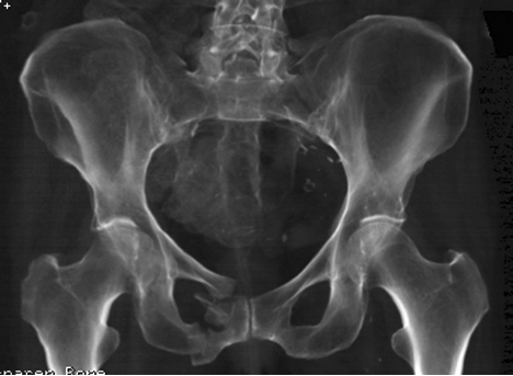 Pelvic Inflammatory Disease Emergency Room Pelvic Inflammatory Disease Emergency Room