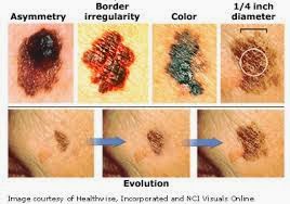 Different stages of Melanoma