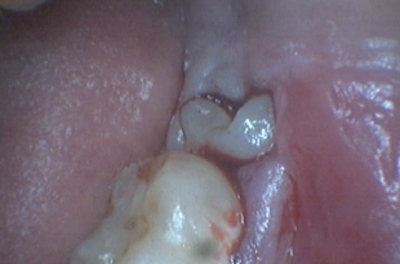 drchetdmd october 2013 erupted tooth