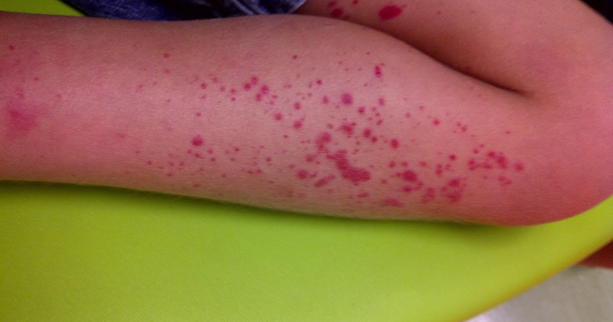 All Around My Home Dealing with HenochSchonlein Purpura (HSP)