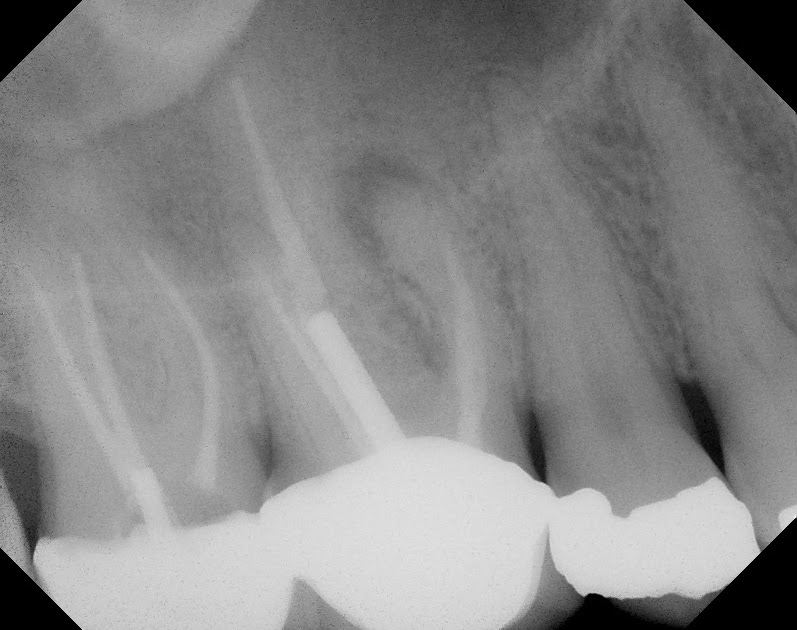 The Endo Blog CBCT to Evaluate Apical Lesions