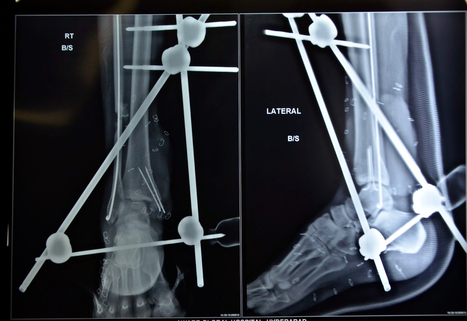 Fracture Treatment Avulsion Fracture Ankle