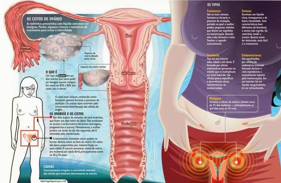 Cisto de Ovário