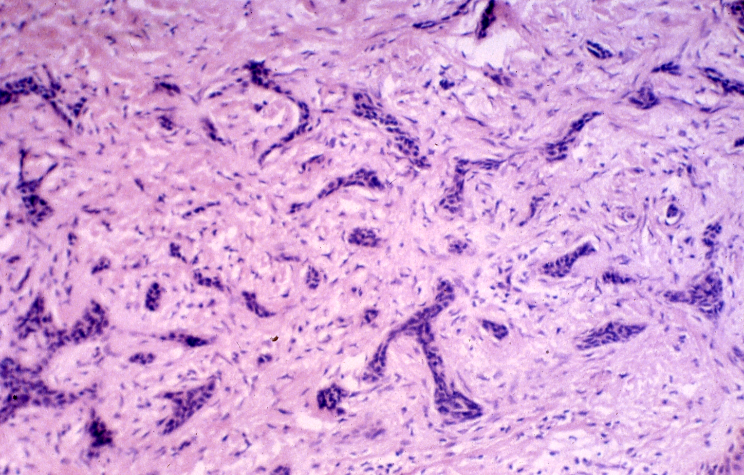 Morpheaform Basal Cell Carcinoma Images
