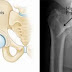 Early Surgery for Hip Fractures in Older May Improve Outcomes