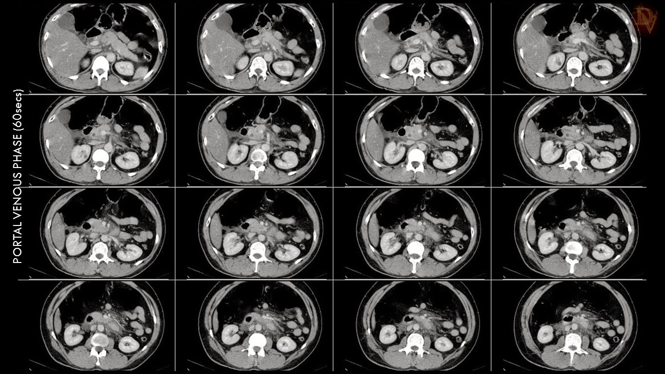 Ultimate Radiology : Acute Pancreatitis with hemorrhage and Pancreas