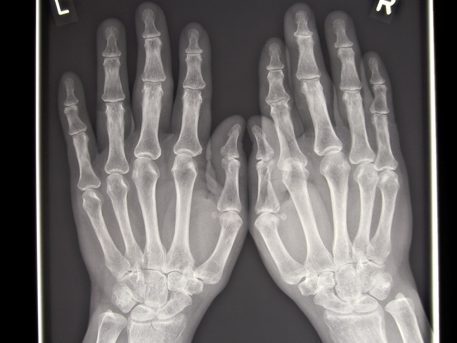 Rheumatologe Rheumatoid Arthritis Radiographic Progression