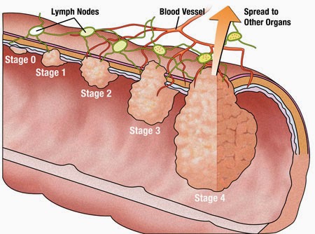 cancer of the colon dipnb clinical tutorials general surgery dr colon cancer mass size