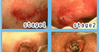 nursing diagnosis for decubitus ulcer 7 nanda nanda books meningitis diagnosis