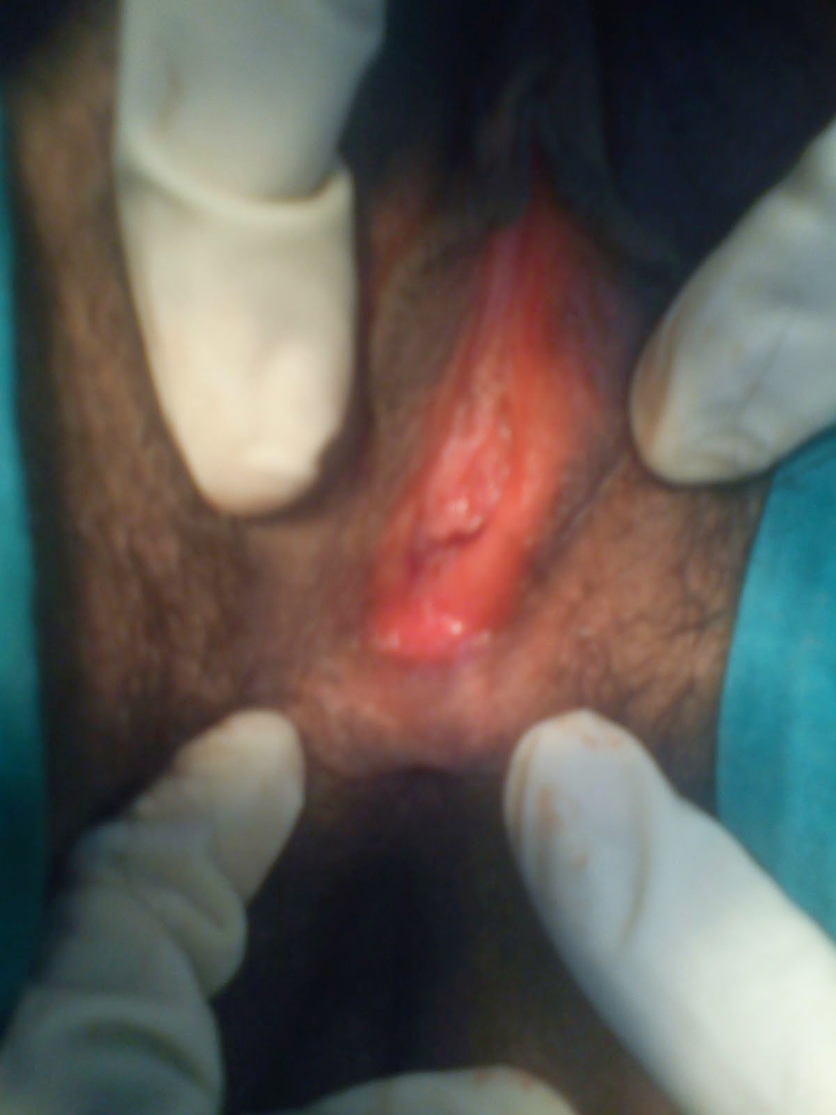 Hymen reconstruction surgery