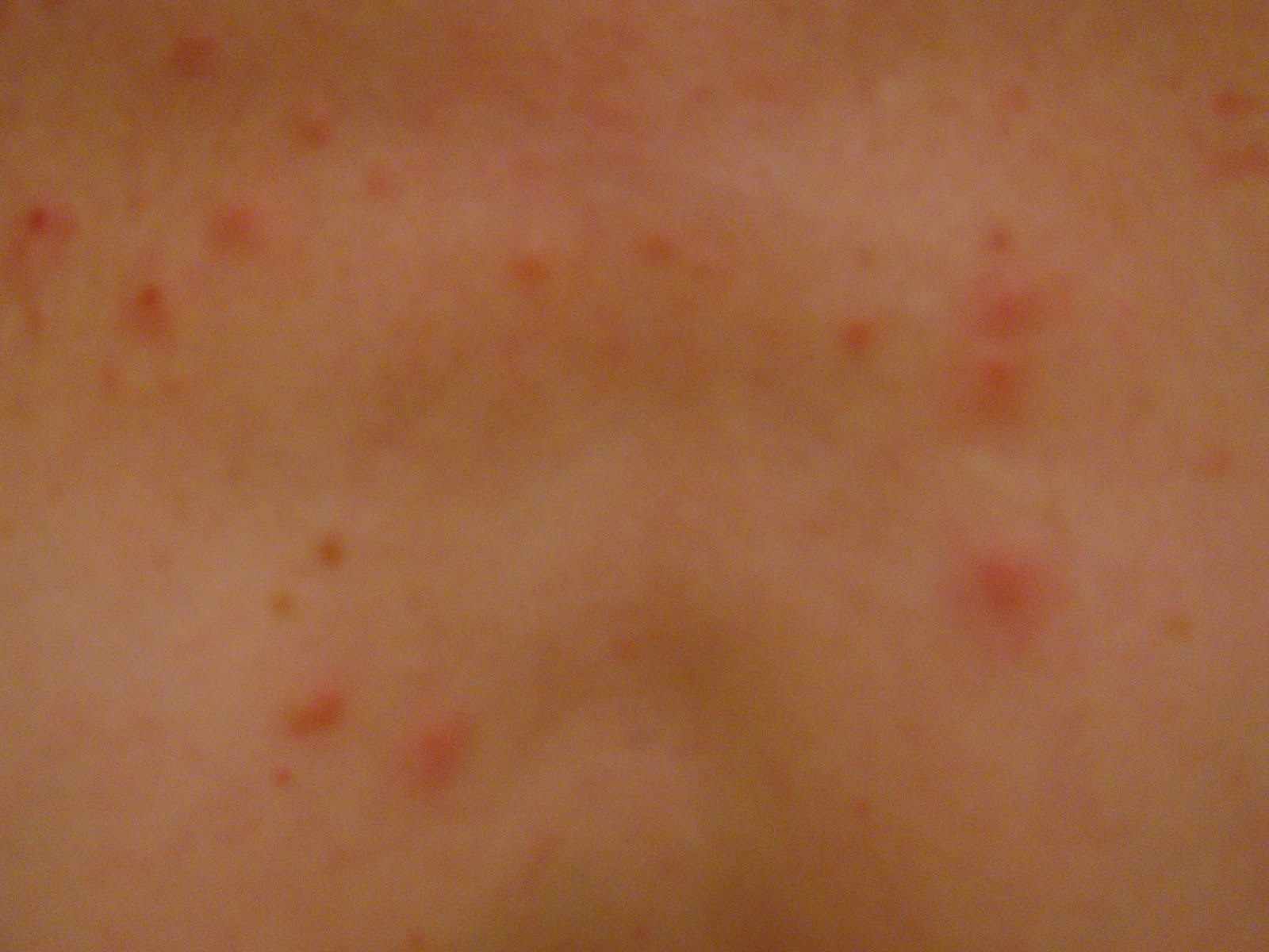 Cutaneous candidiasis as related to Dermatitis Pictures