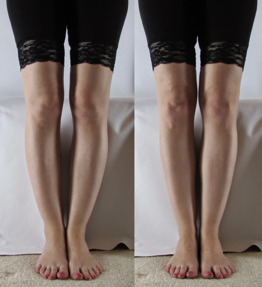 Tibial Torsion teefasr