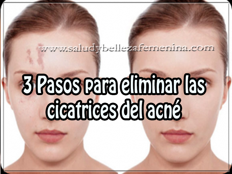 3 Pasos para eliminar las cicatrices del acné Cuidados del rostro , belleza , 3 pasos para eliminar las cicatrices del acné