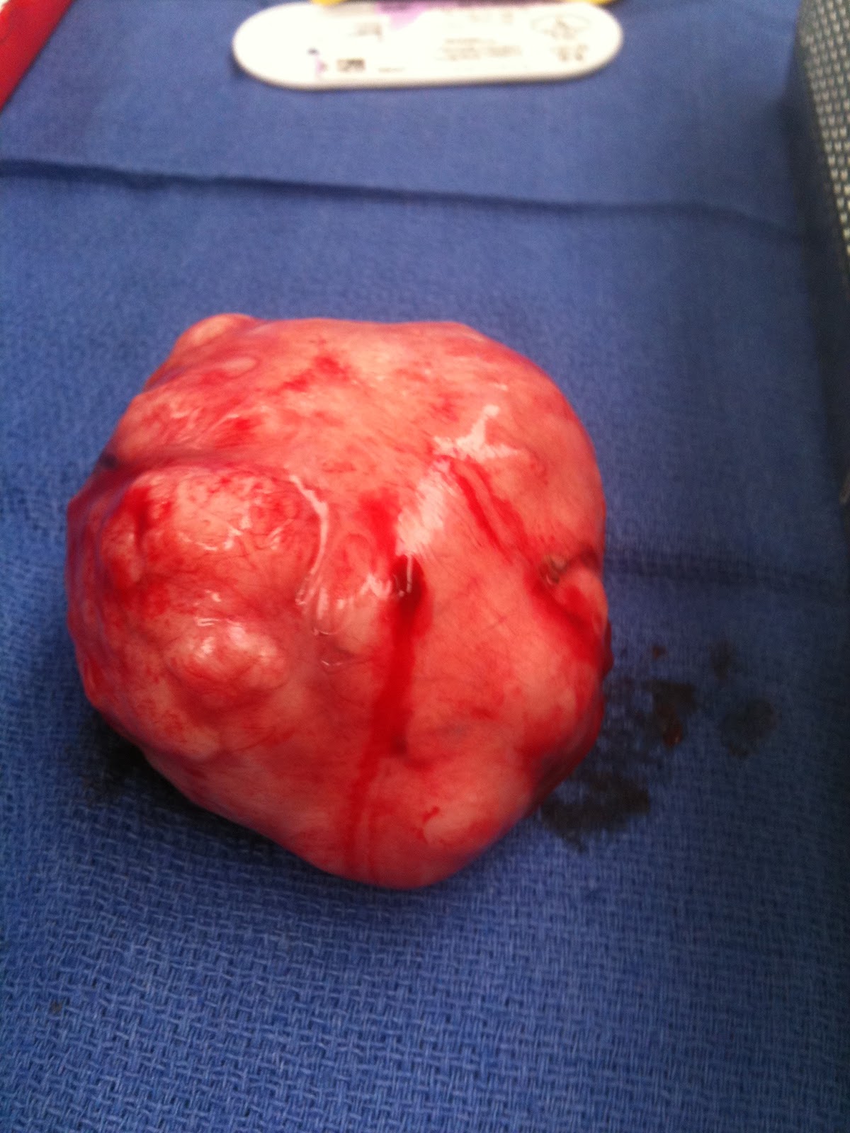 Uterine Surgery Pictures