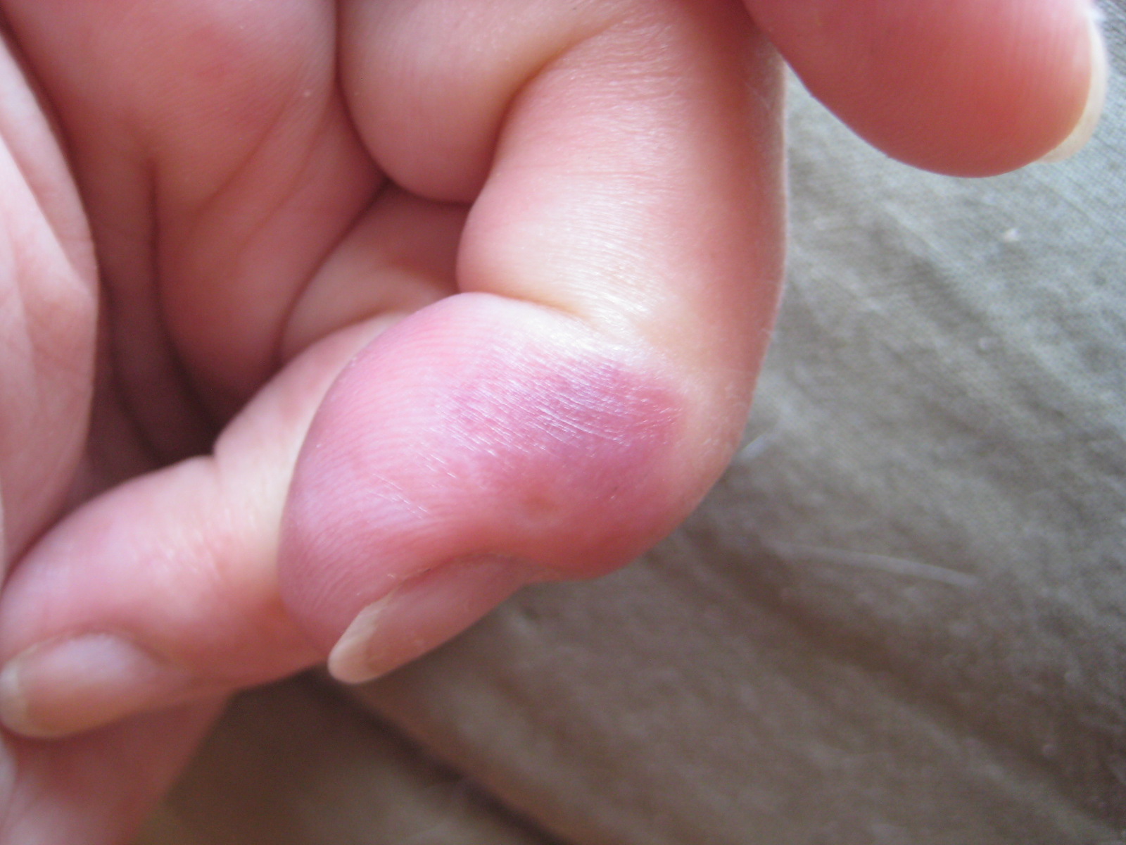 Fly Bites: Pictures, Symptoms, and Treatment - Health Fly Bites: Pictures, Symptoms, and Treatment - Health
