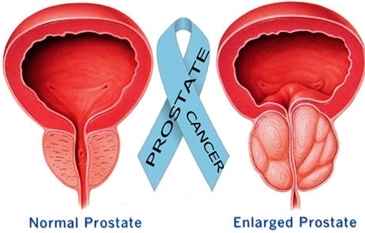 Prostate Cancer Specialist Pennsylvania
