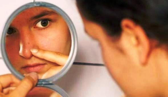 Tips Menghilangkan Lubang Bekas Jerawat Tips Menghilangkan Lubang Bekas Jerawat Lebih Cepat