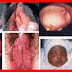 Gonorrhea atau Kencing Nanah thumbnail