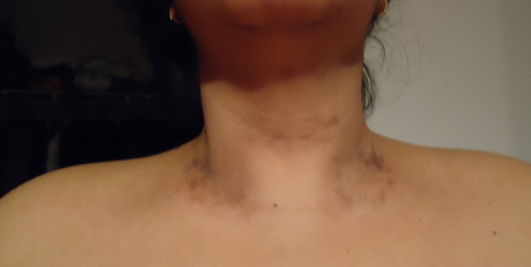 Dry Patch On The Back Of The Neck