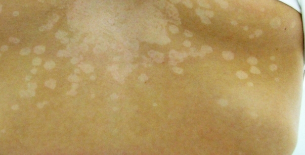 Manchas+Blancas+En+El+Pene Como eliminar las manchas en la piel - Blogmujeres.com - HD Wallpapers