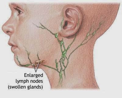 http://www.obatdemamkelenjar.com/2014/03/obat-kelenjar-getah-bening.html