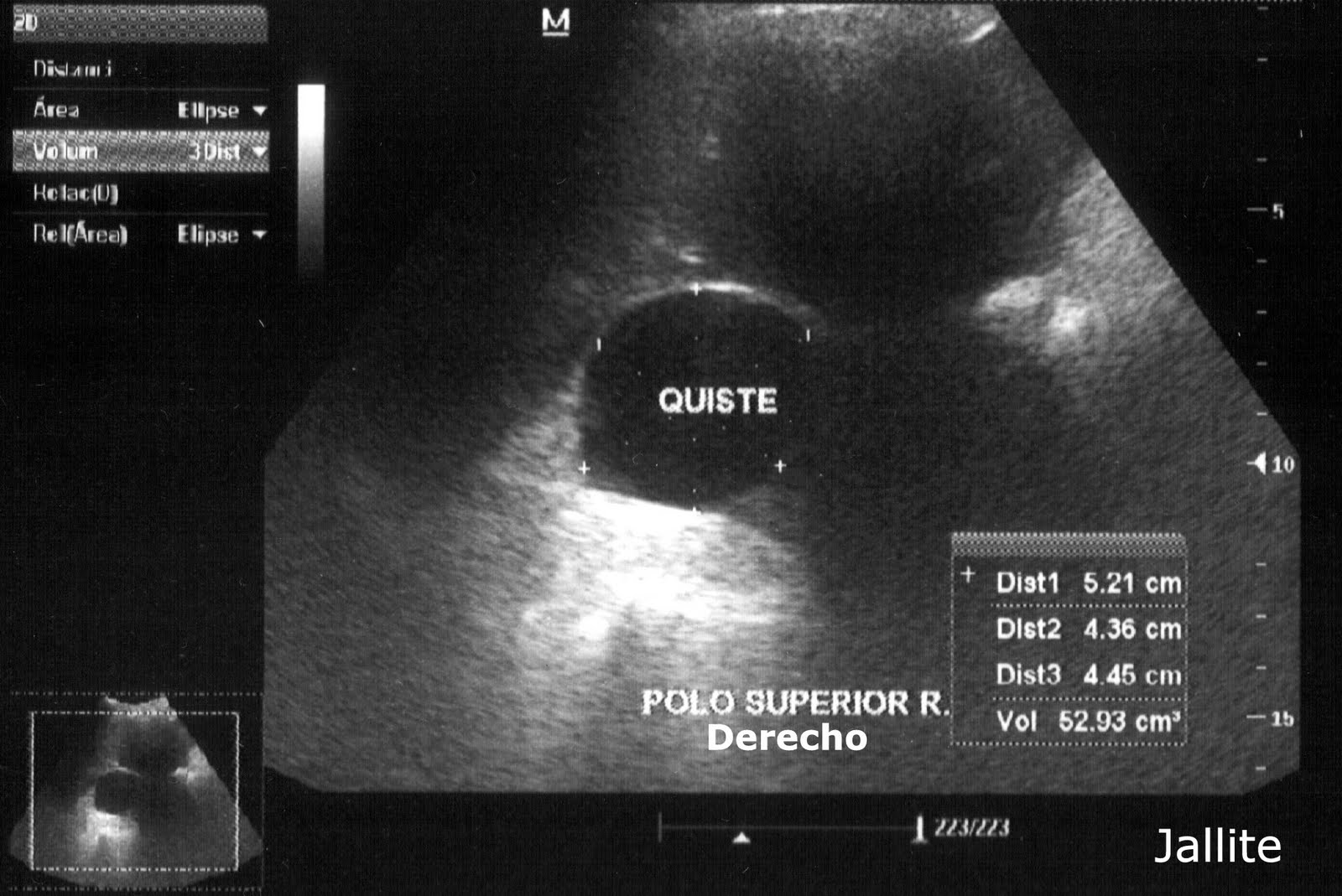 Cancer de Estomago y....