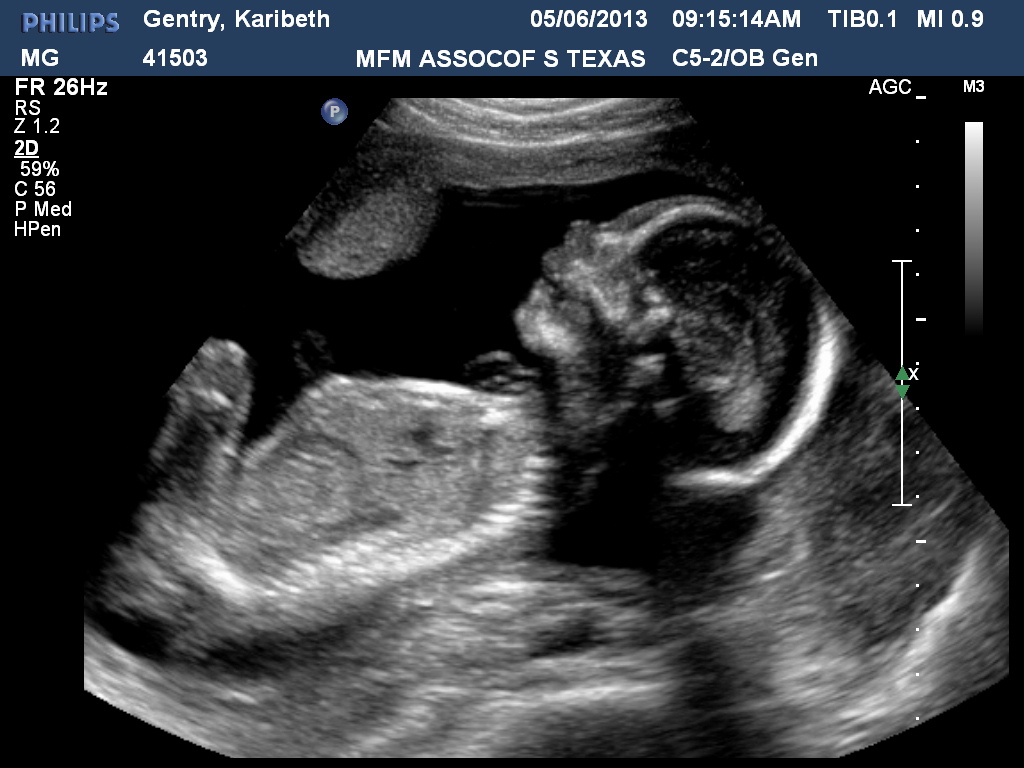 The Gentry's Journey Level II Ultrasound