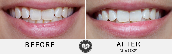 BlanX Advanced Whitening Toothpaste (Before & After)