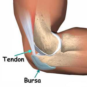 Resultado de imagen para bursitis rodilla